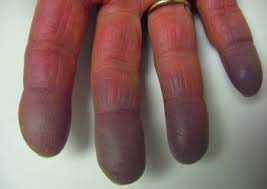 cianosis